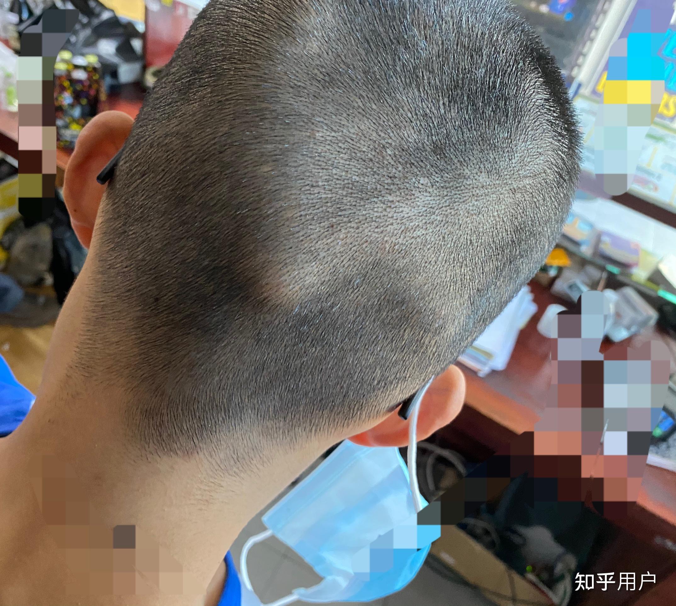 后脑勺有反骨是怎样的体验?