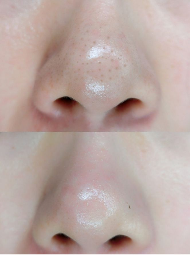 有没有去黑头比较靠谱的黑头贴呀. - 知乎