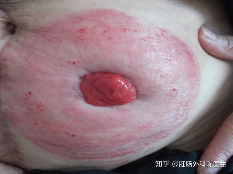 为什么说造口形态变化是造口渗漏的重要原因