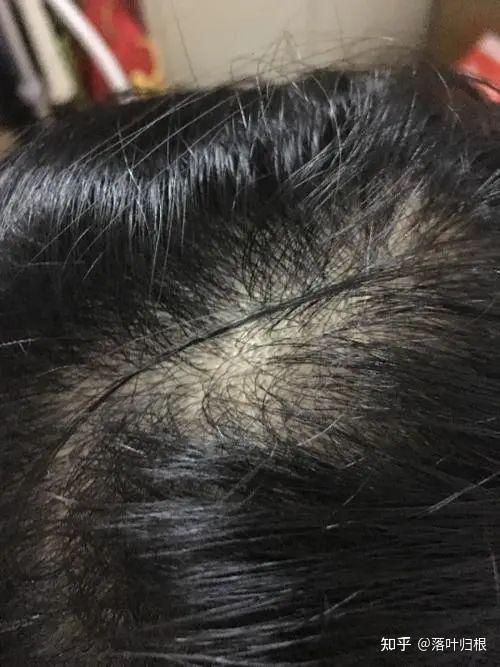 掉头发,毛发稀疏还能重新长回来吗?有没有过来人分享点防脱经验?