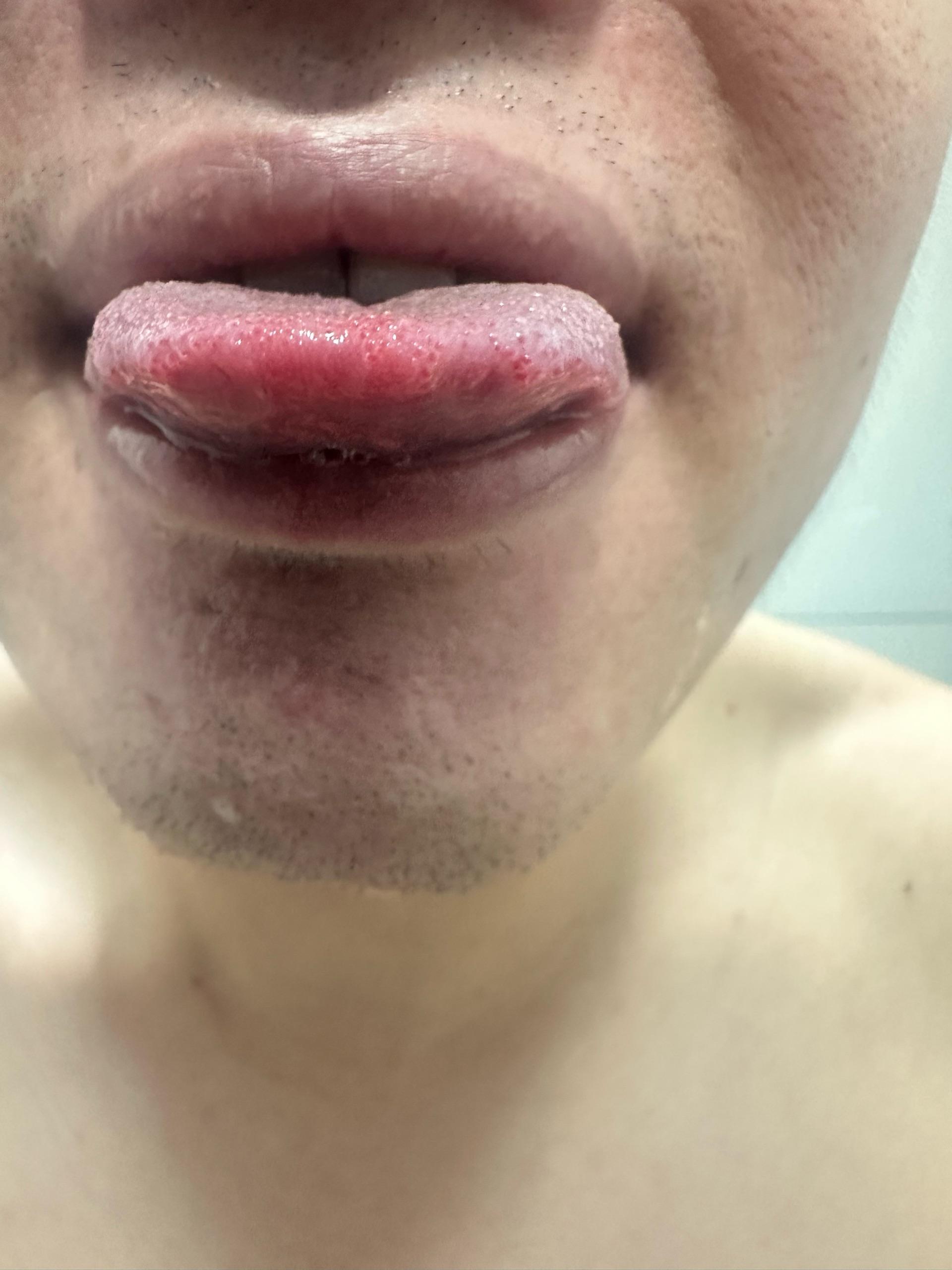 舌诊分享:舌尖红点和黑点都代表了什么?中医两个案例告诉你! - 知乎