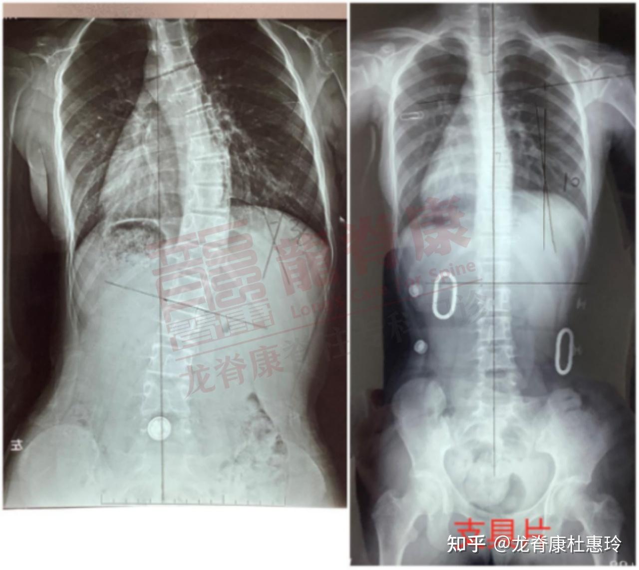 超过30度的脊柱侧弯怎么改善