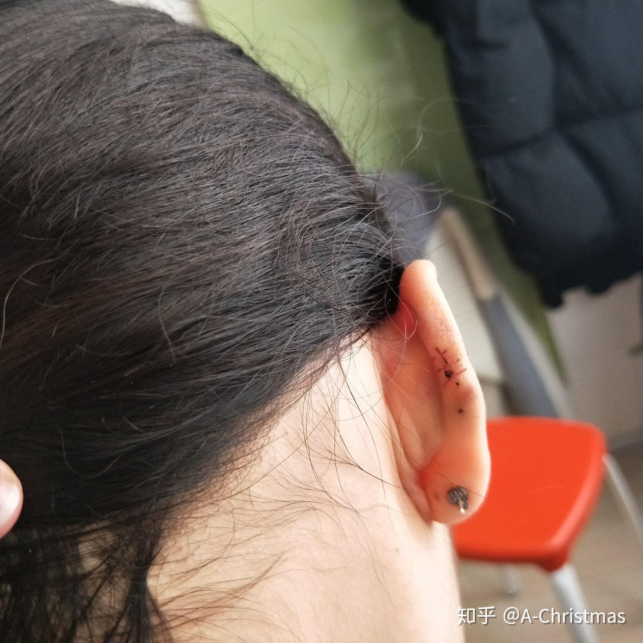 怎样解决耳朵打了耳洞后长了个肉球的糟糕状况啊看了那么多医生都说是