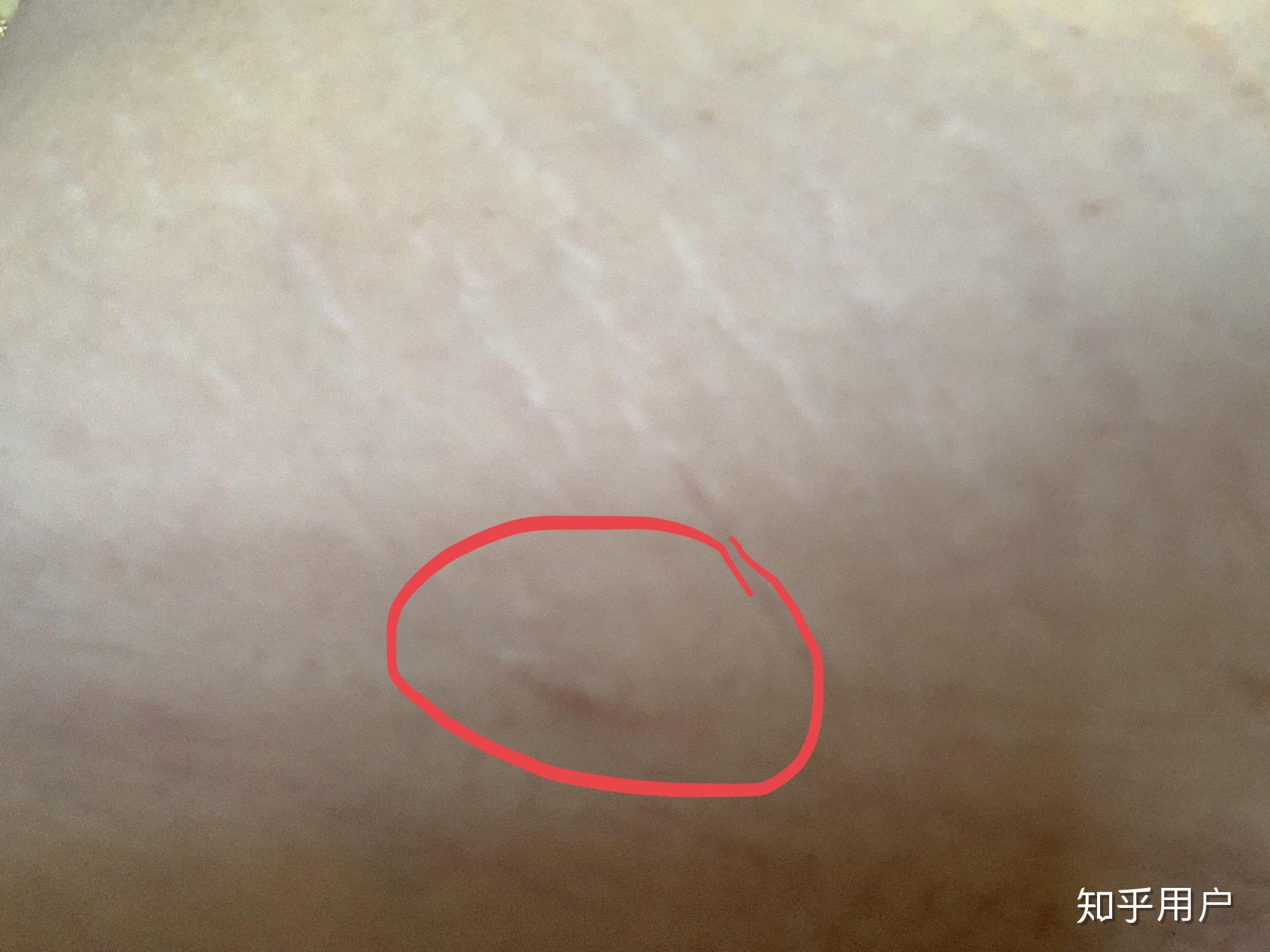 女朋友肚子左右两边和肚脐眼有手术刀口请问是做过什么手术