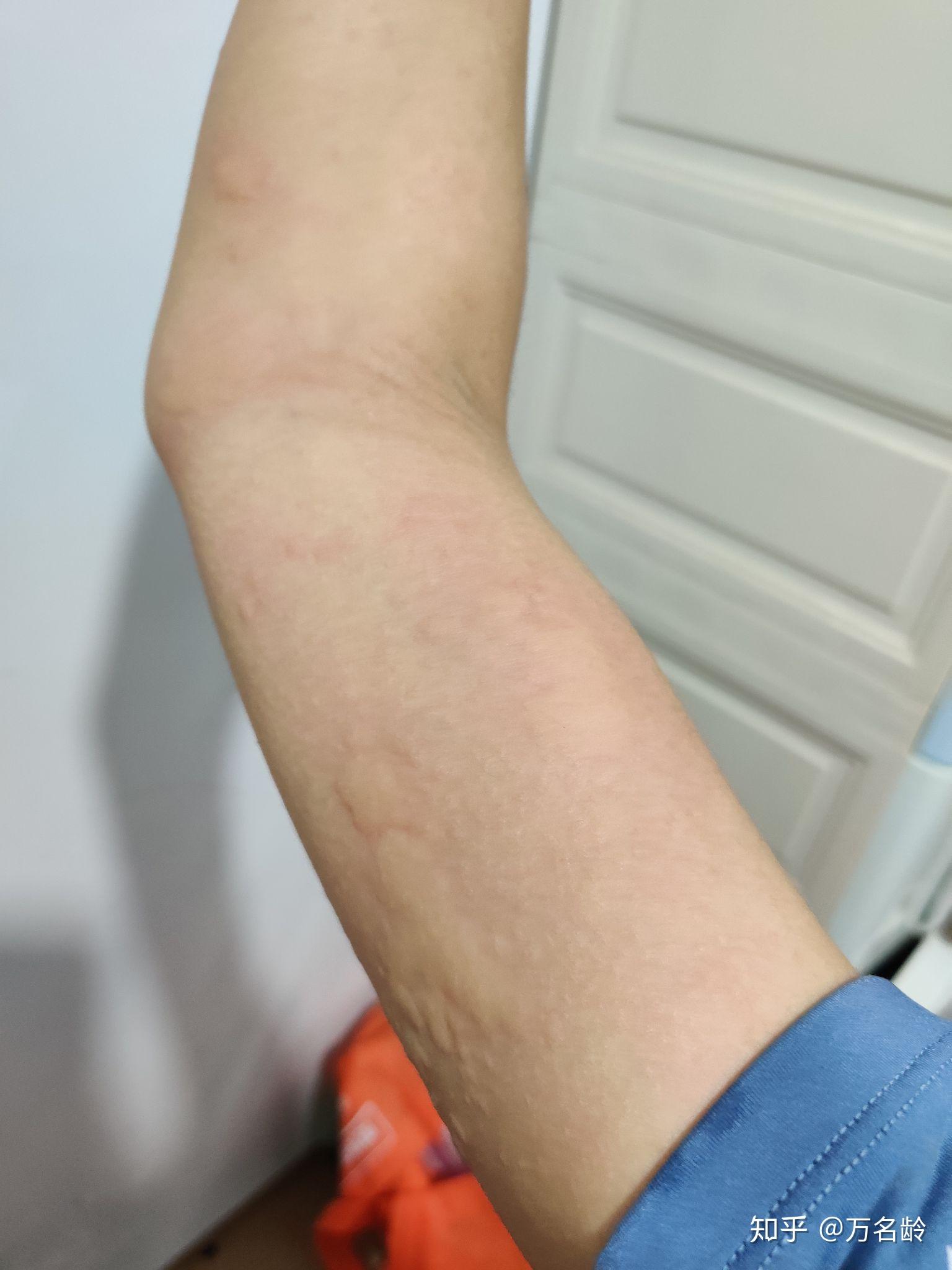 对狗过敏的症状有哪些? - 知乎