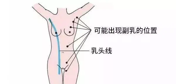 副乳大成这样正常吗