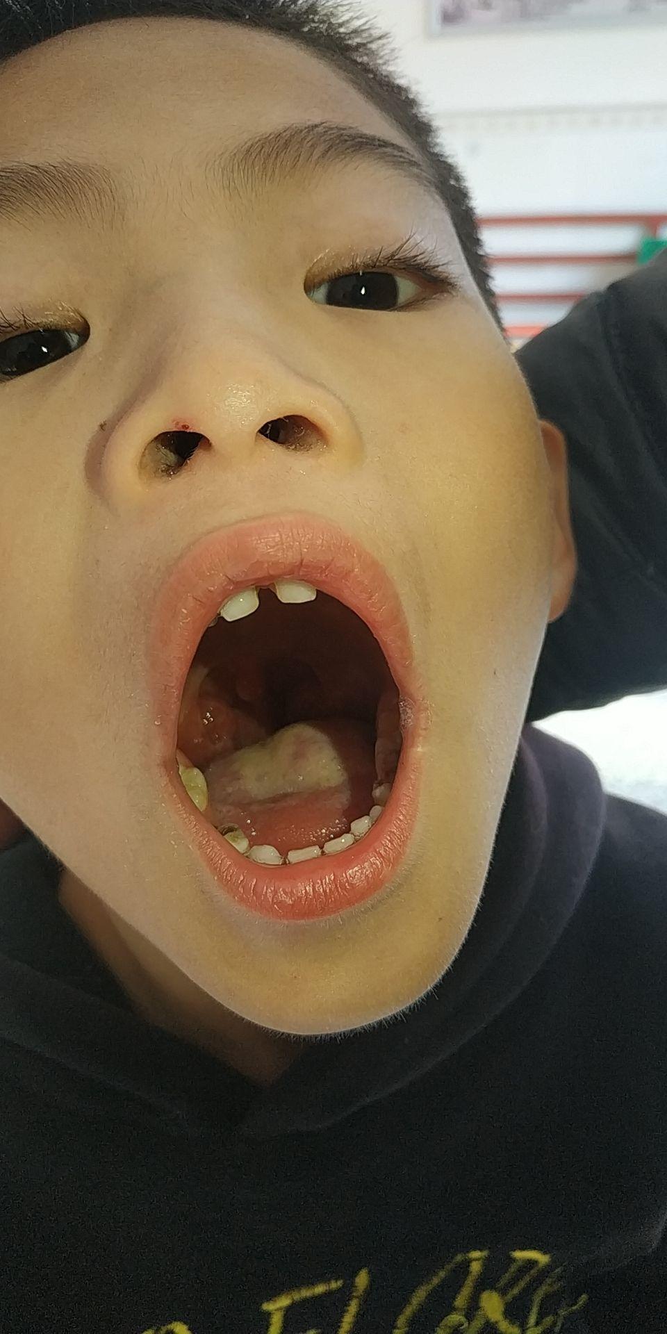 宝宝咳嗽有痰,喉咙发炎怎么护理? - 知乎