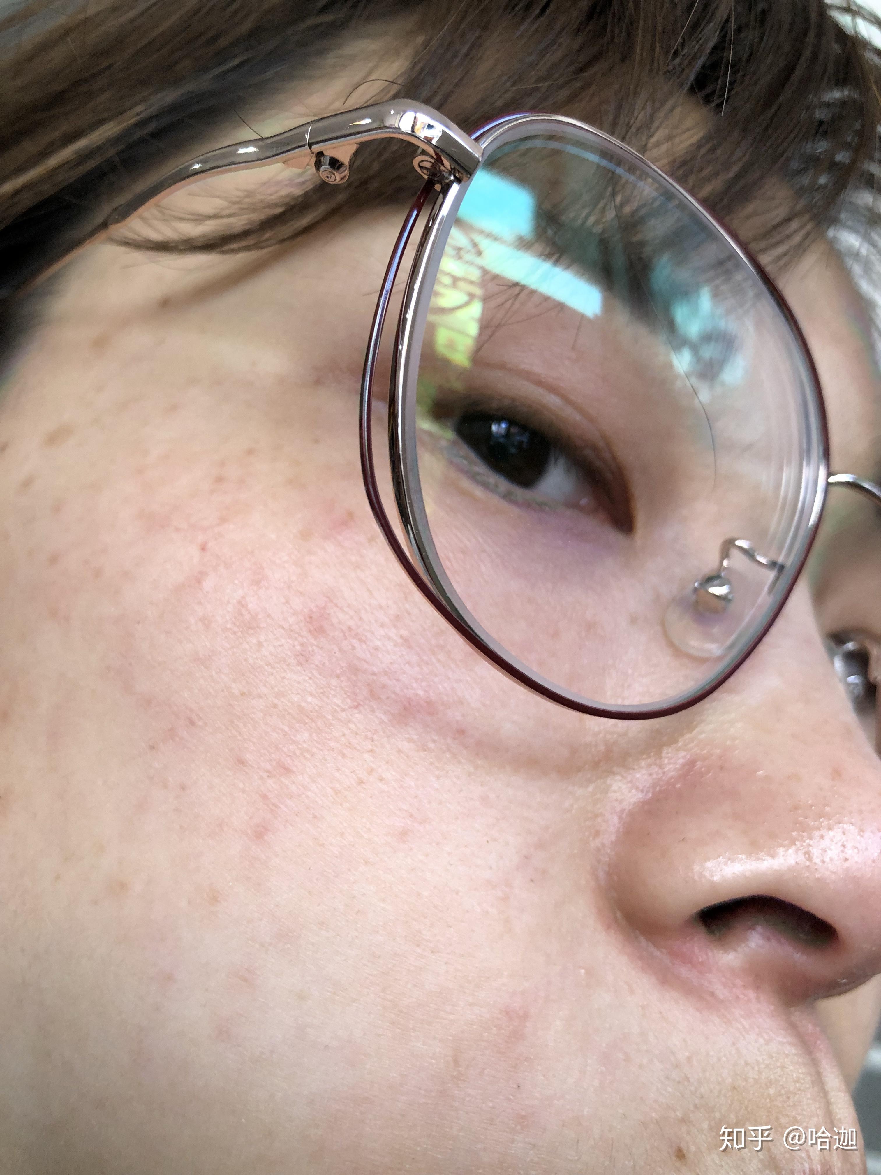 激素依赖性皮炎通常如何治疗