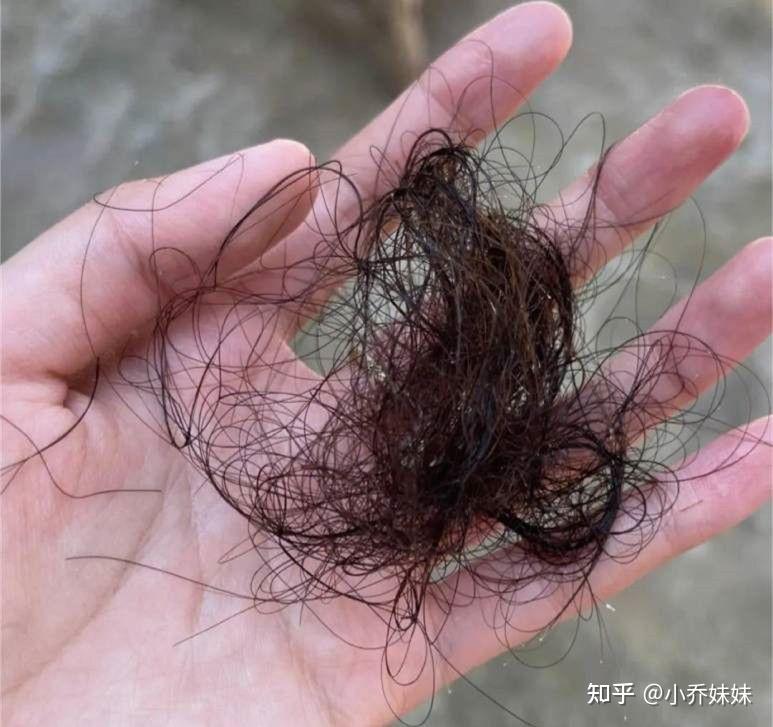 脂溢性脱发两年毛囊是不是死掉了?