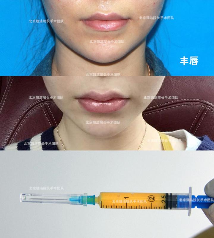 唇部太薄 玻尿酸或自体脂肪填充两种方式可丰唇 - 知乎
