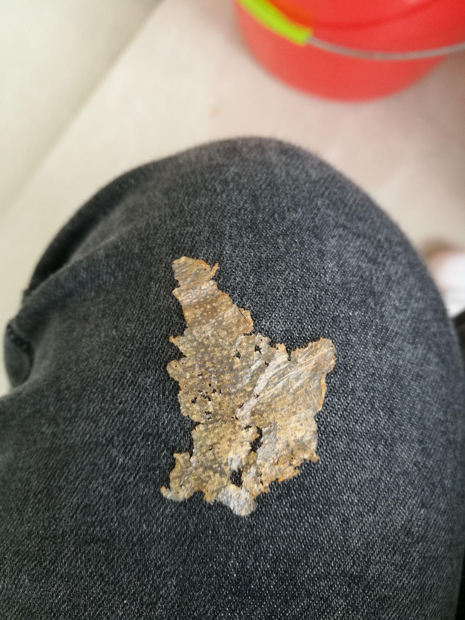 请问头部脂溢性皮炎产生的大块白色片状鳞片到底是什么物质以及诸多