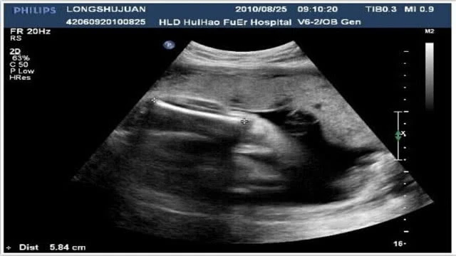 为生男孩他们喂孕妇吃转胎丸却害惨孩子成畸形阴阳人