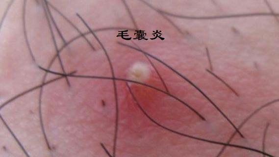 毛囊炎、疖、痈、皮脂腺囊肿怎么区分? - 知乎