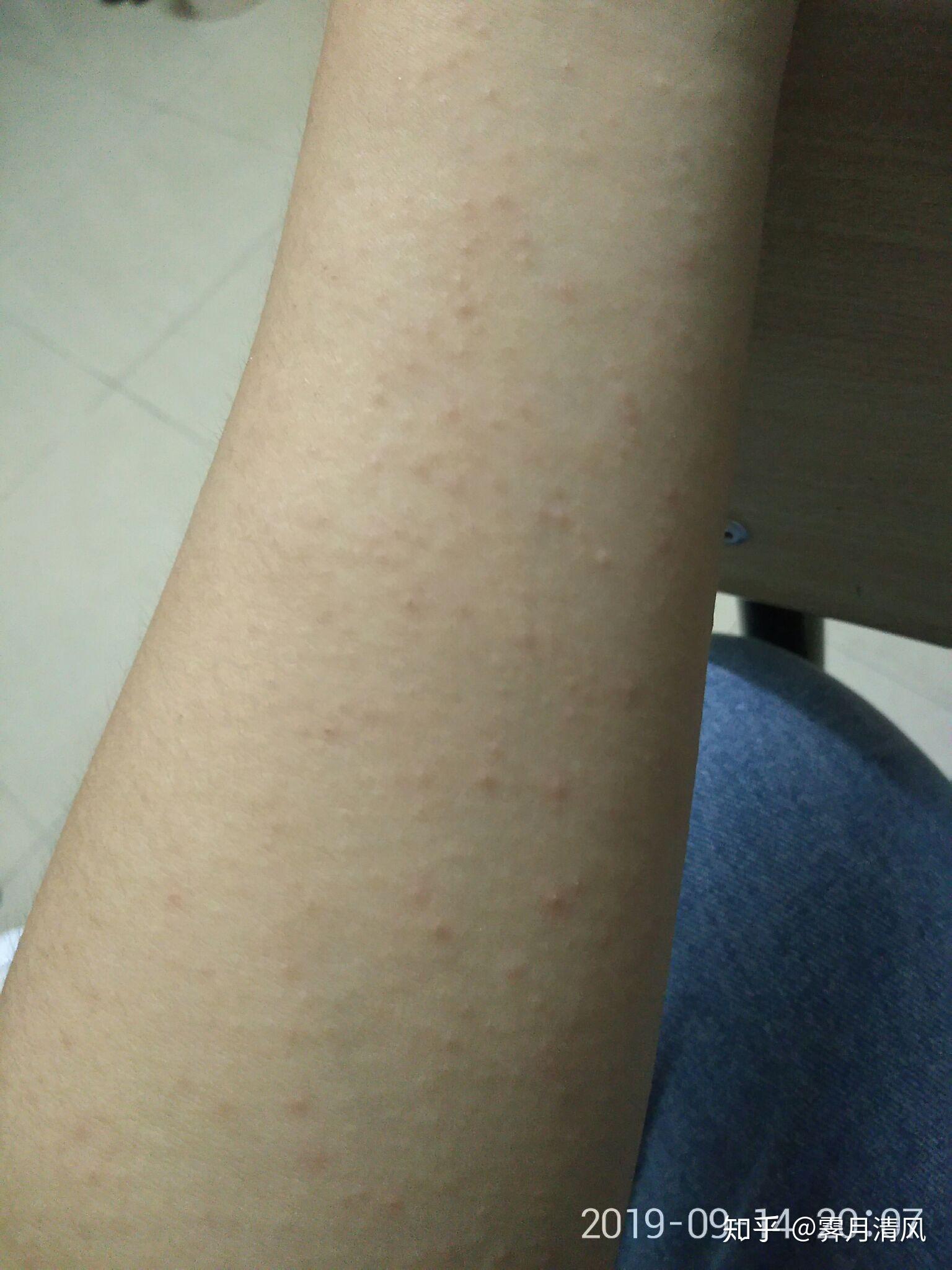 为什么我抹凡士林身体乳会过敏啊?