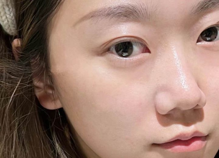 黑眼圈细纹杀手!为什么【协和皮肤科医生+中科院博士】推荐的眼霜淡纹消肿这么猛?2个月养成星星眼?! - 知乎