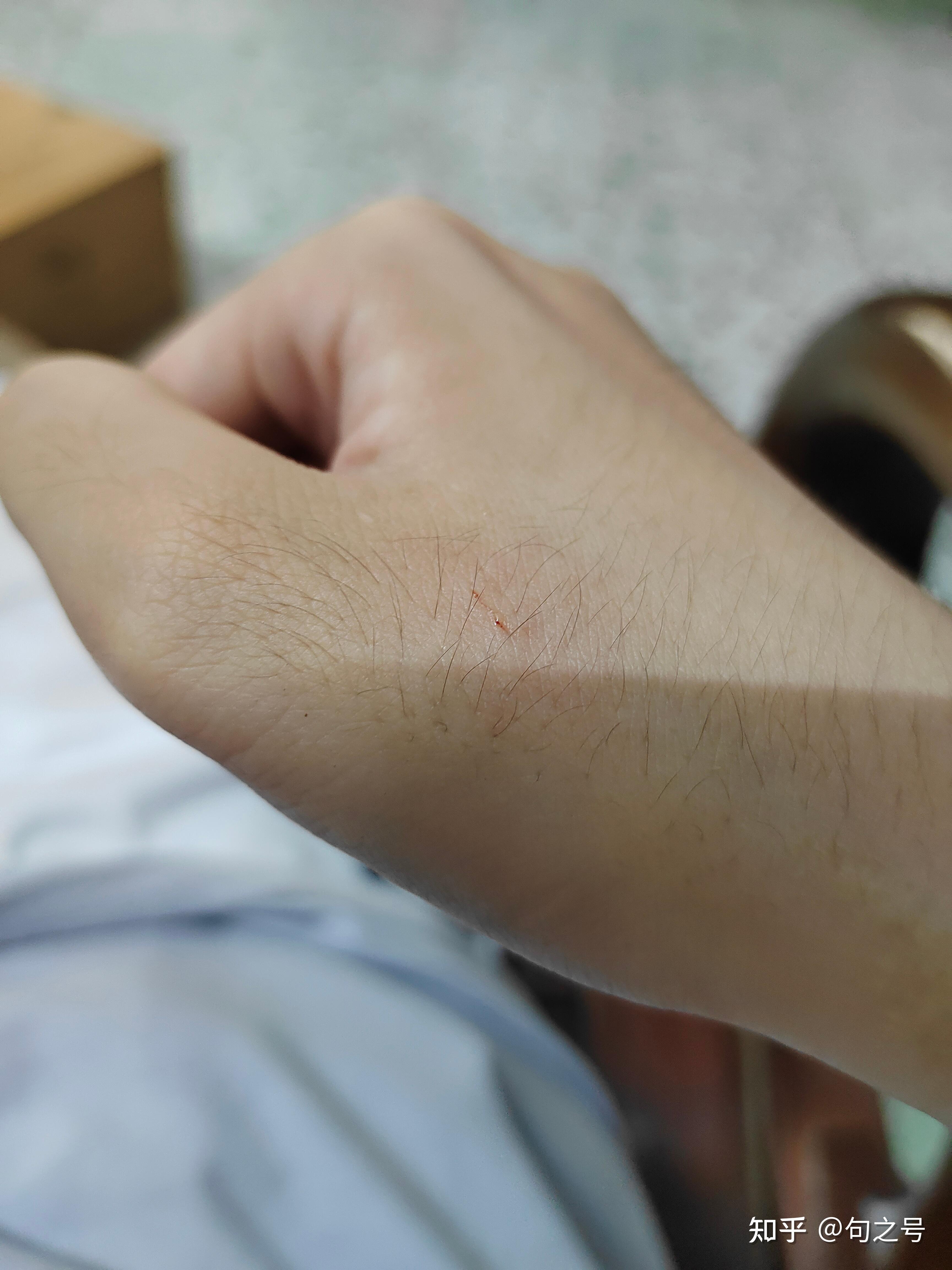 刚刚被猫抓伤了出了一点血大概是表皮的我刚刚舔了一下伤口用不用打