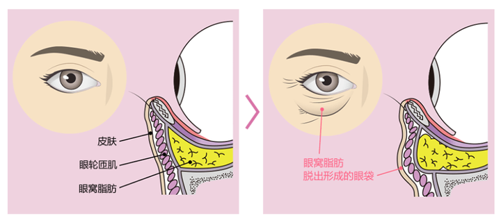 眼袋结构图并带名称图图片