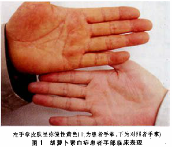 吃南瓜皮肤真的要变黄吗