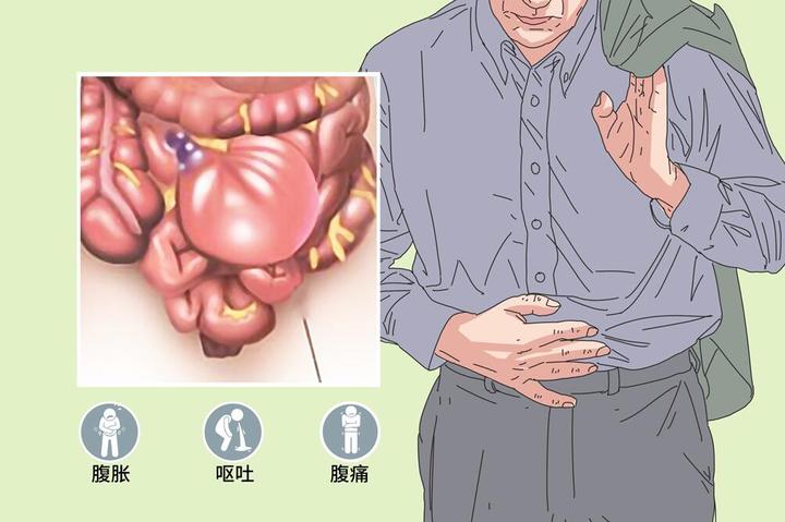 肠梗阻病人图片图片