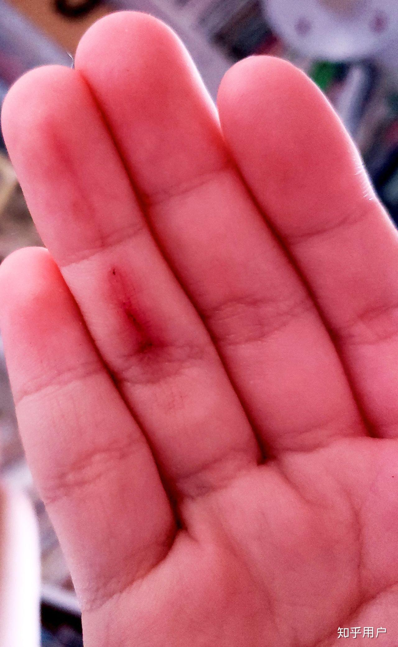 为什么有的女生手受点小伤都要发朋友圈动态求安慰啊