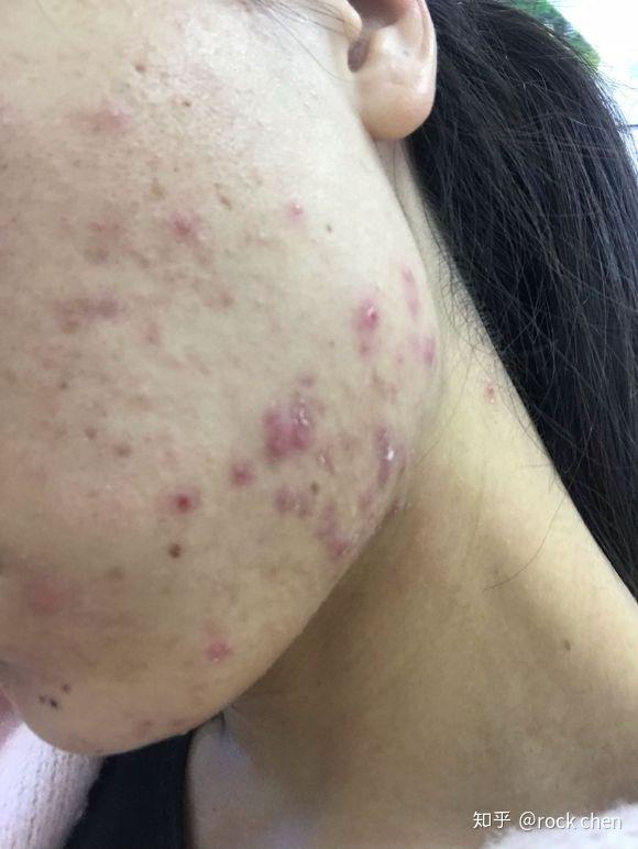 下巴两侧有结节性的痘痘