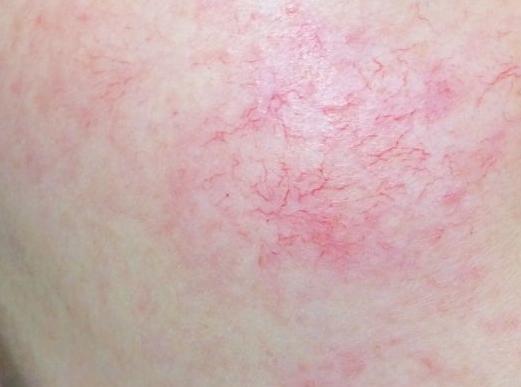 皮肤为什么有红血丝