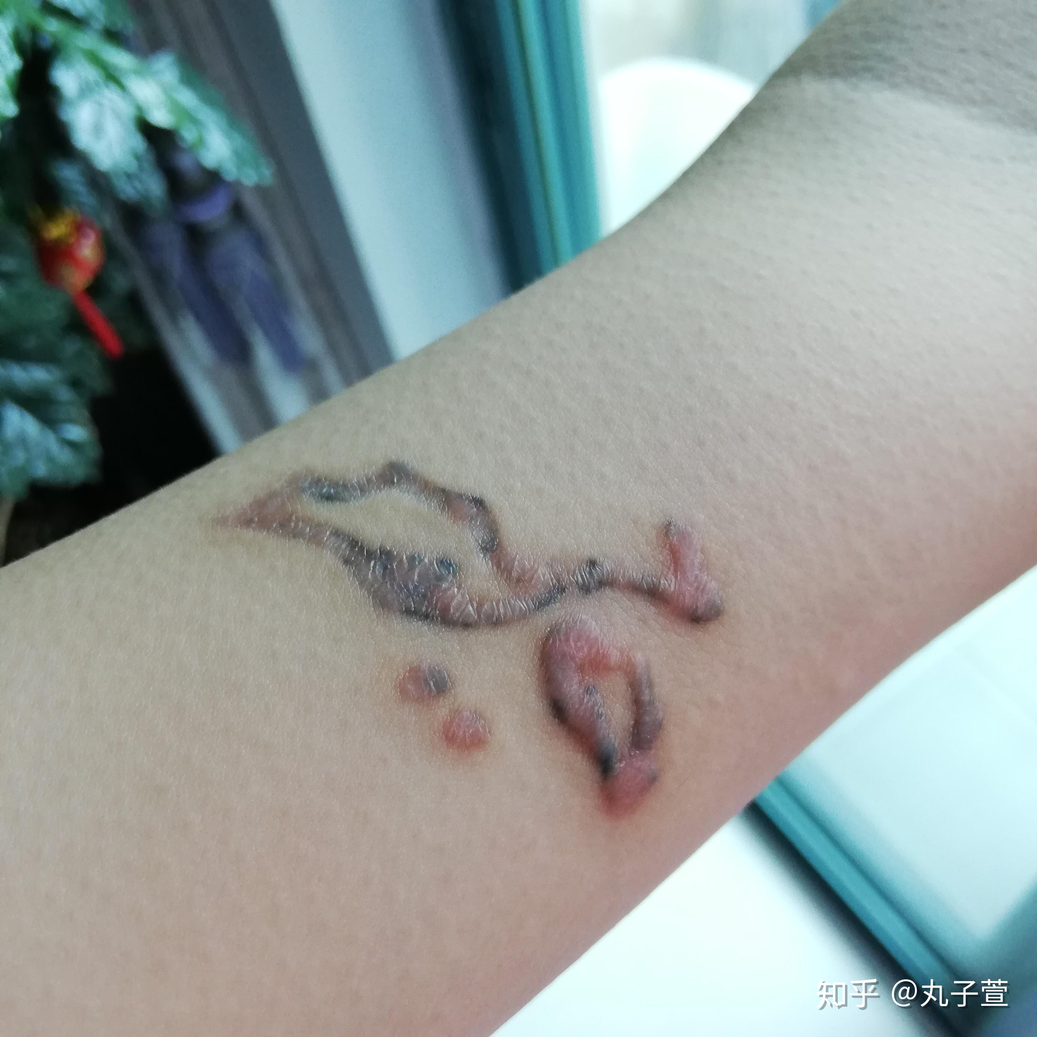 纹身增生了怎么办