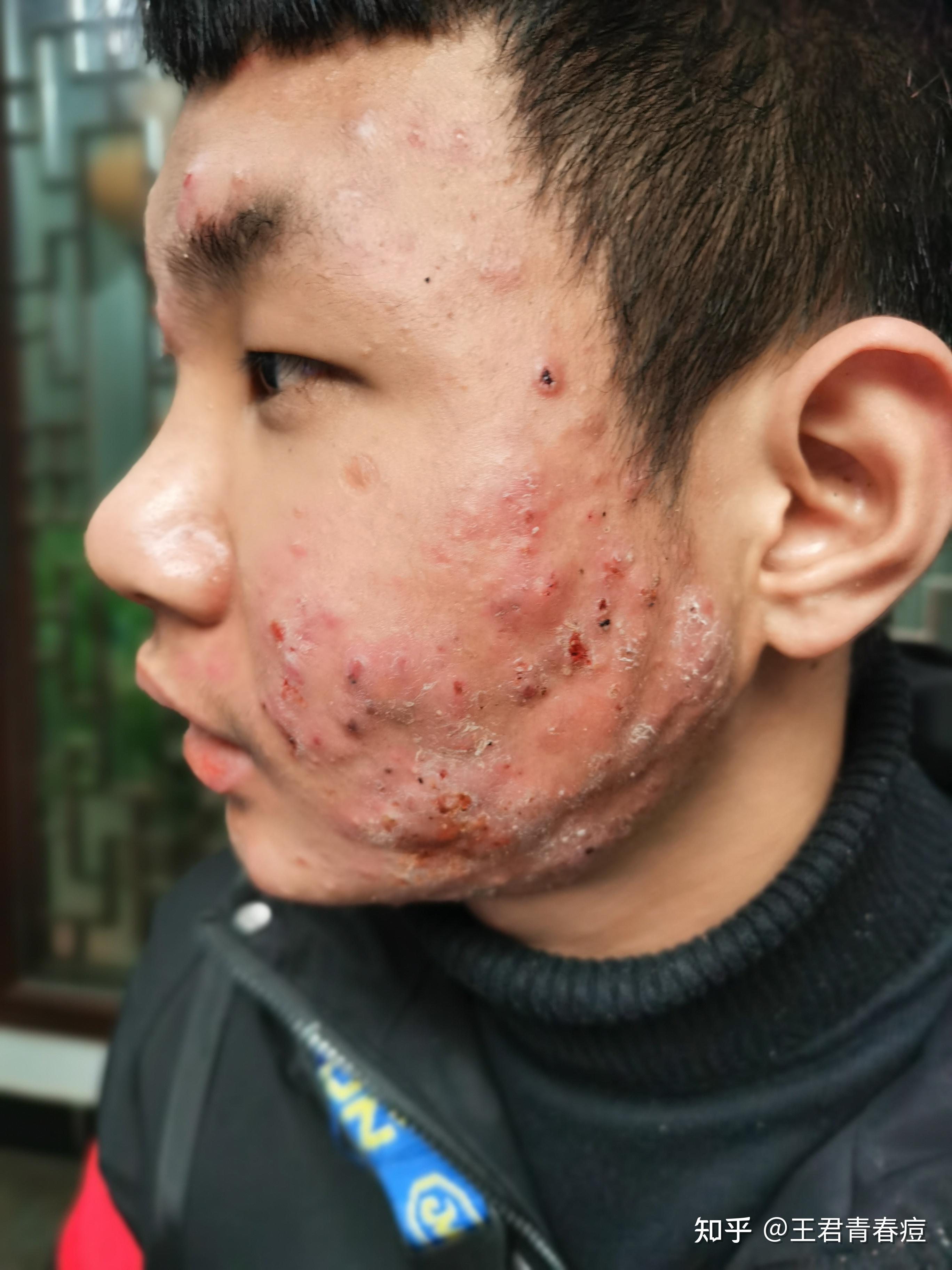 脸上痘痘很严重怎么办