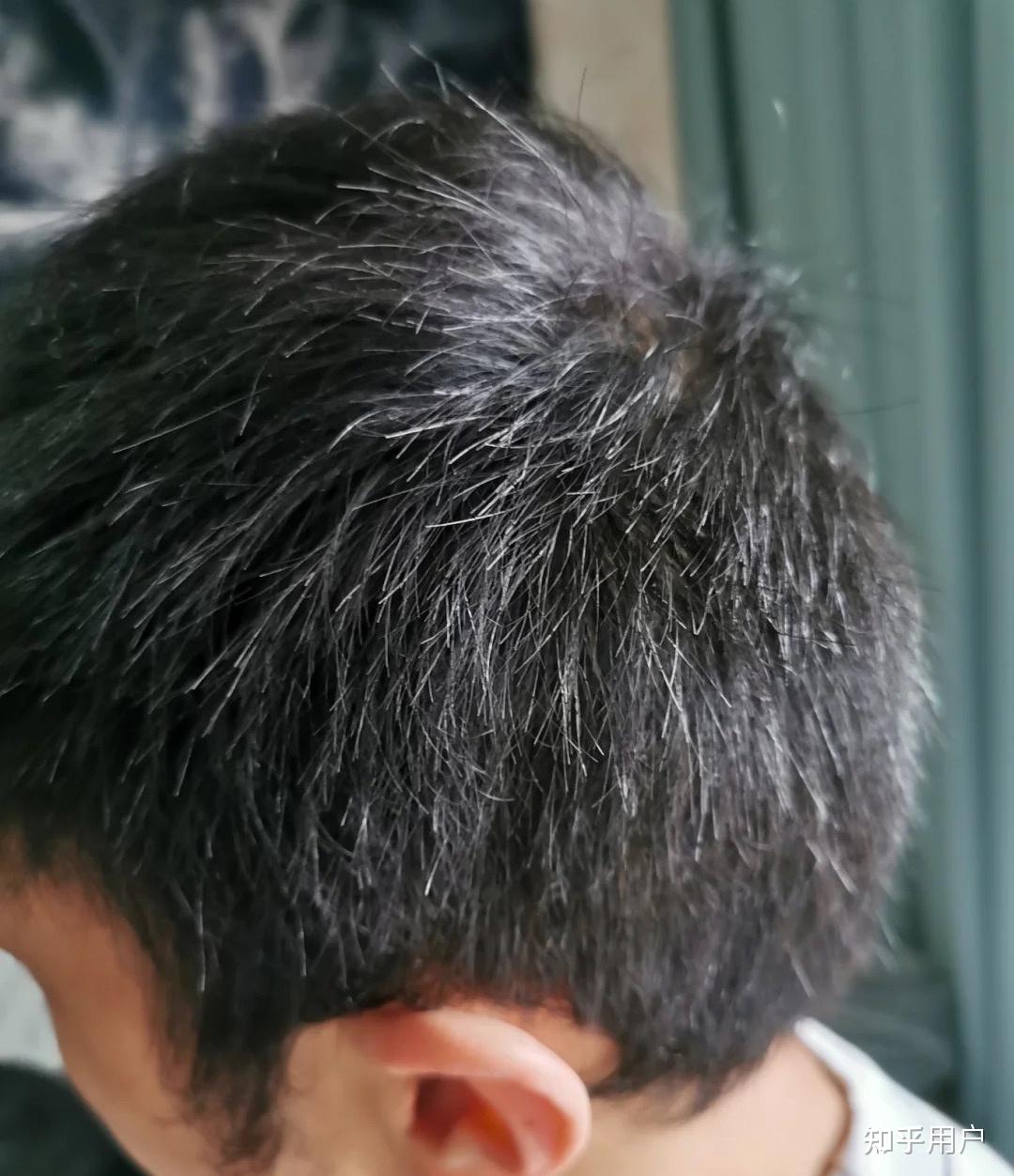 大三的一个男生21岁头顶漩涡处头发少得可怜以前头发很茂密晚上基本12