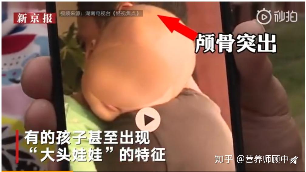怎么看湖南郴州再现大头娃娃疑固体饮料冒充特医奶粉