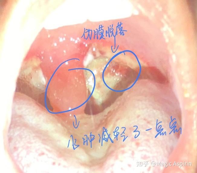 扁桃體切除手術的體驗是怎樣的? - 知乎