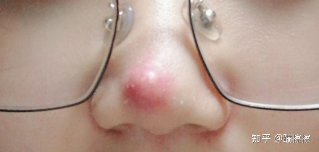 我想知道鼻子上长了这样的痘痘应该怎么办