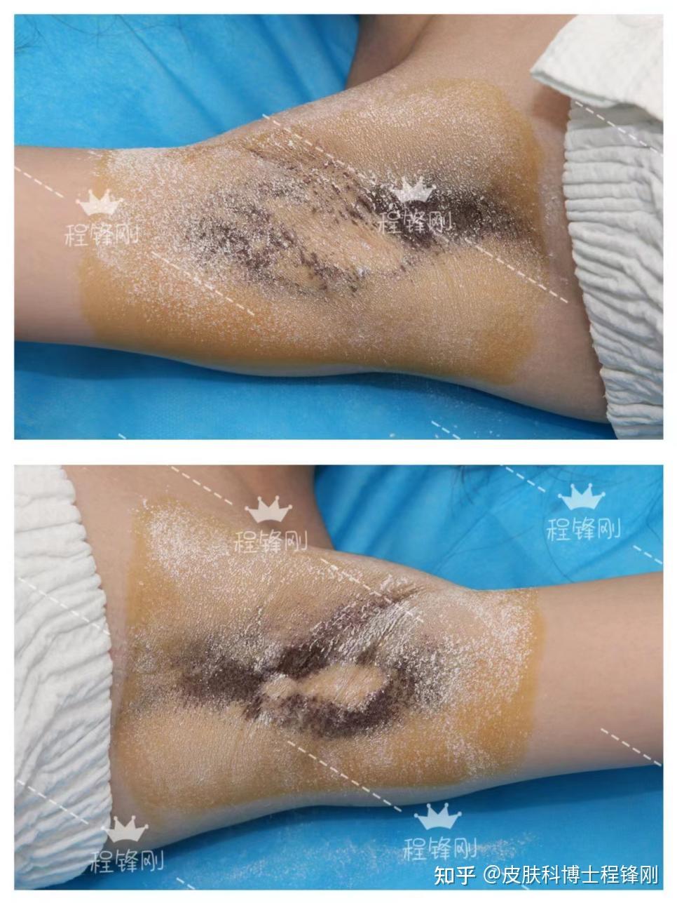 腋臭复发可能跟什么因素有关? - 知乎