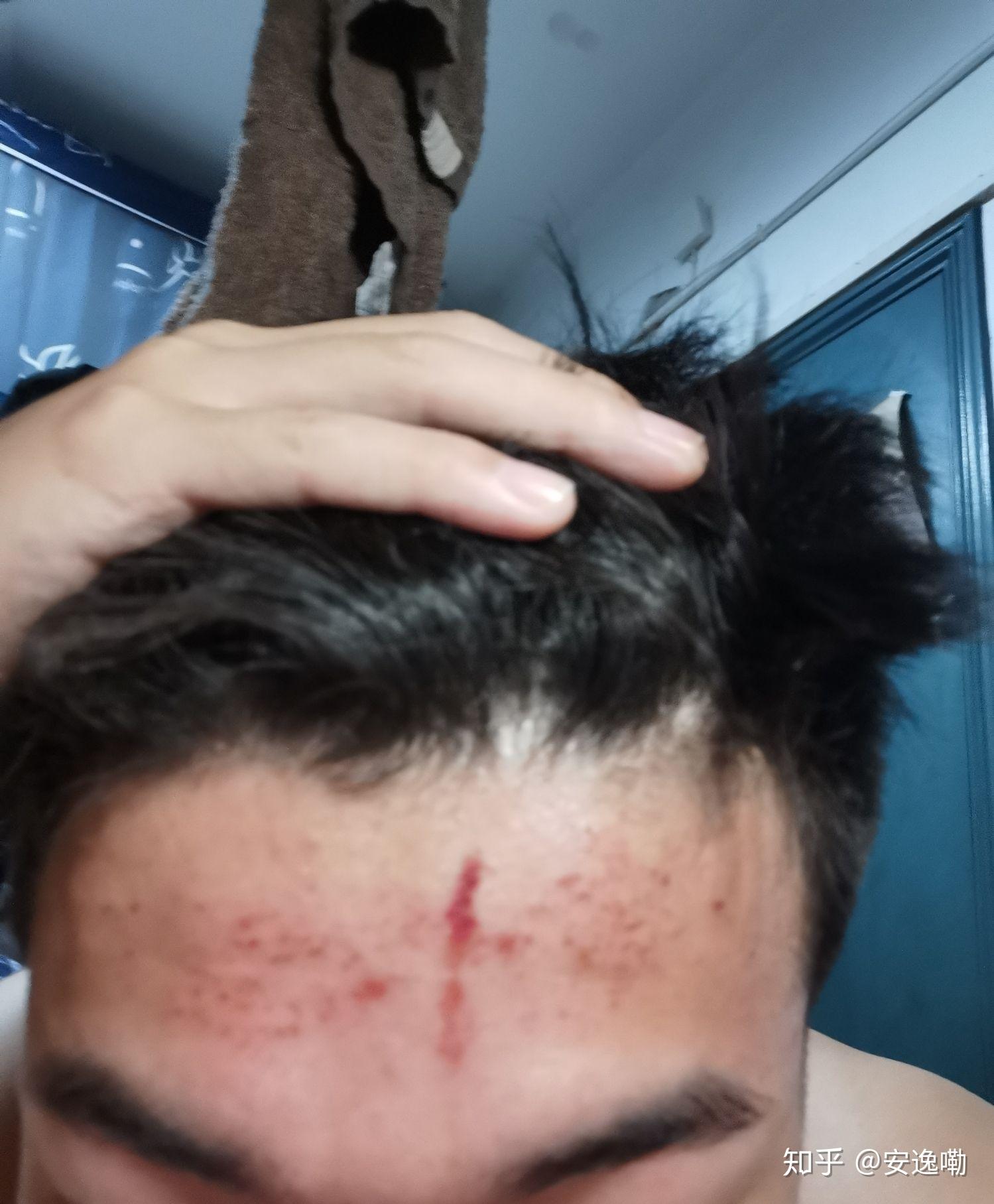 烫发药水留到额头上额头红了一片然后那里就变粗糙了