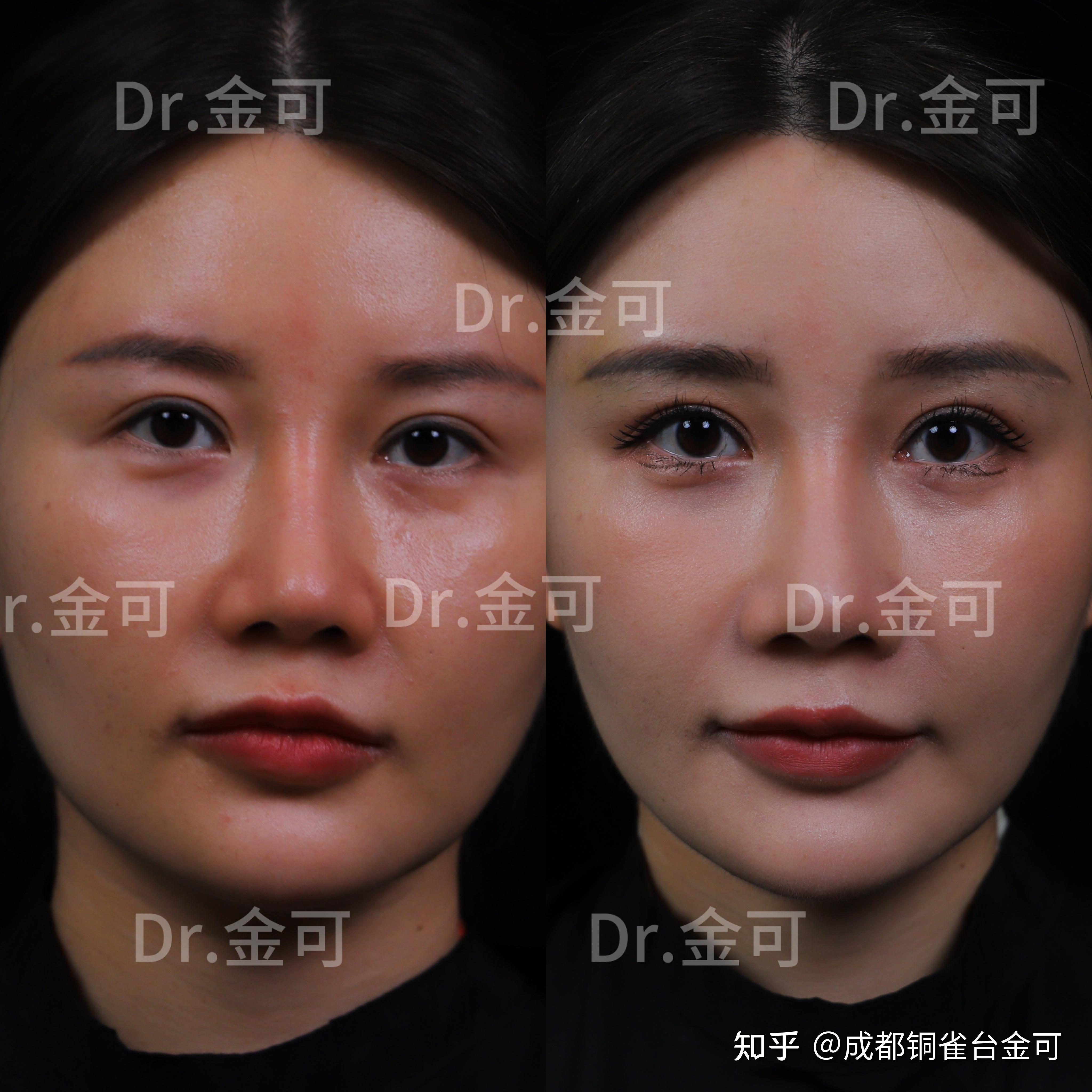 眉弓填充改善眼凸