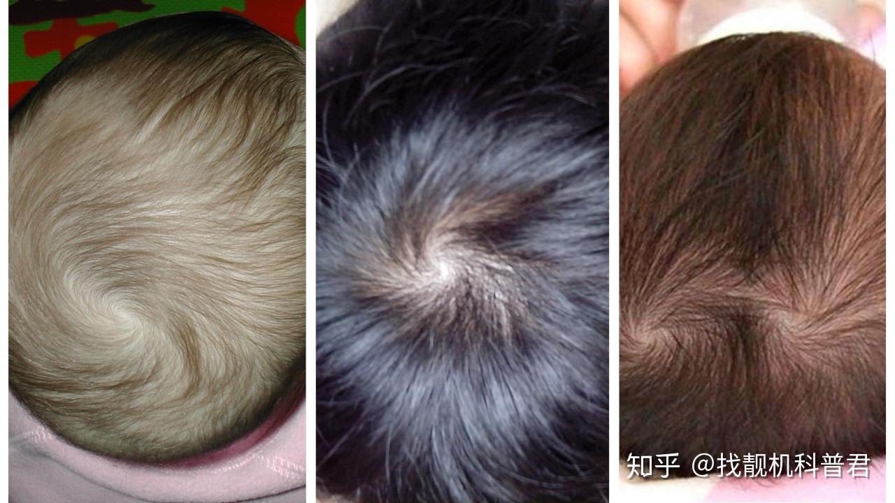 为什么人会长发旋，1 2 3个发旋分别代表什么？ - 知乎