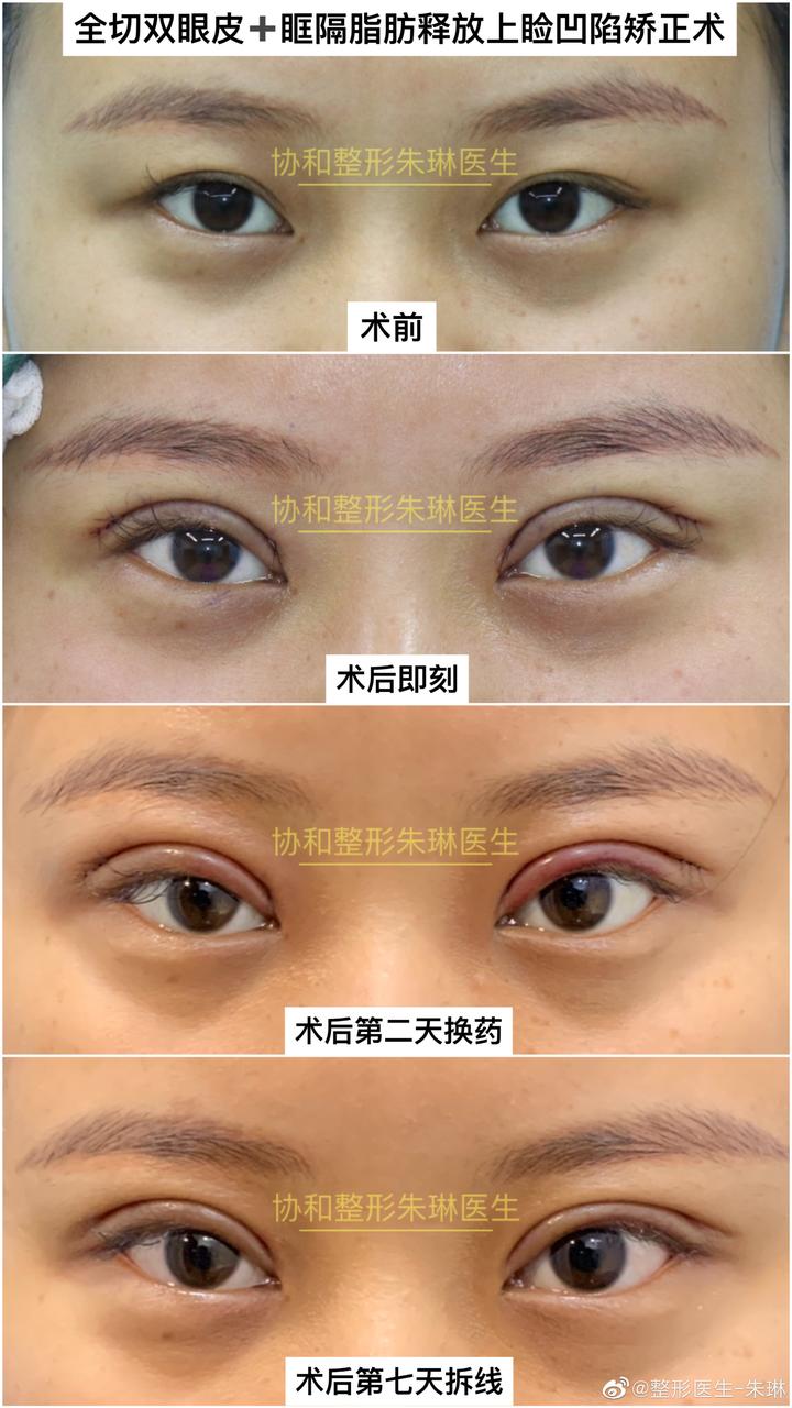 北京全切双眼皮 眶隔脂肪释放上睑凹陷矫正术。 - 知乎