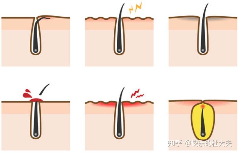 刮胡子也能患上“毛囊炎”?提醒:6种方法或能预防,平时爱卫生 - 知乎