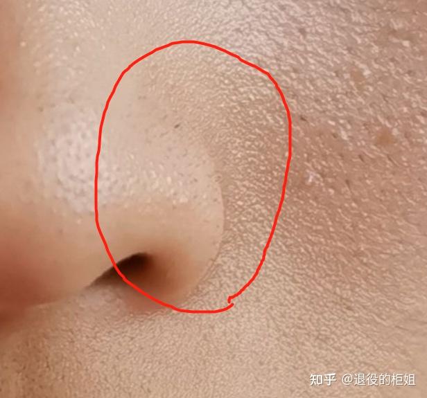 请问我鼻子上是黑头吗? - 知乎