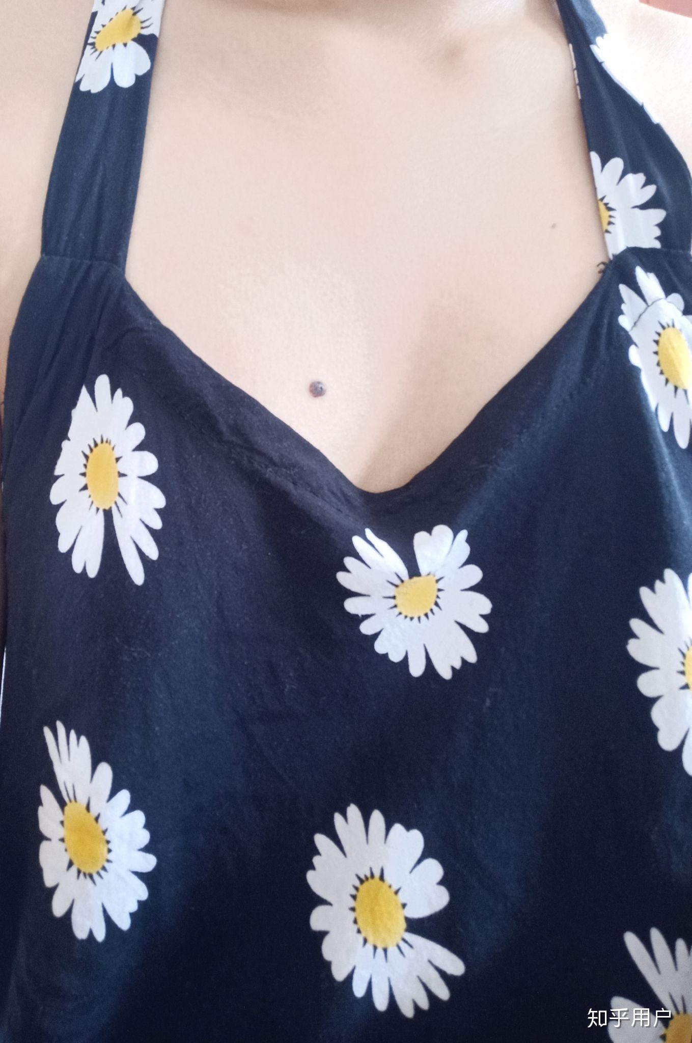 胸上一颗痣从小就有,随乳房长大变大,往四周变淡,好像还不太规则,会不