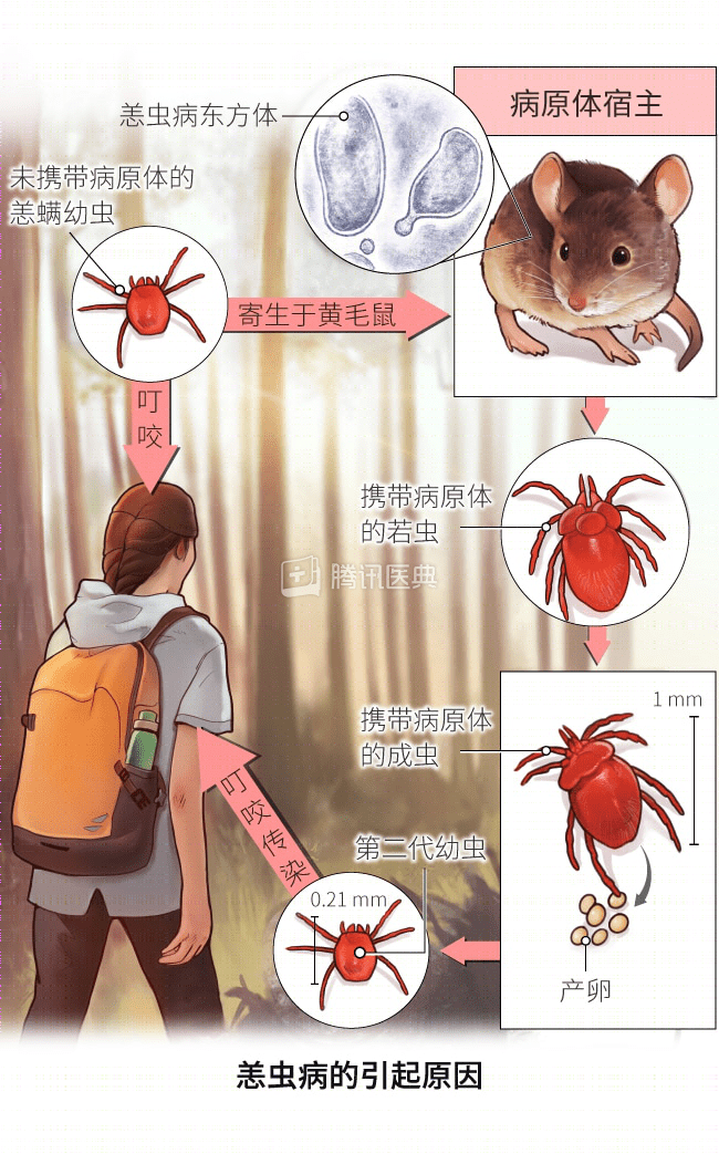 一女子撸猫后呼吸衰竭陷入晕迷,被确诊为恙虫病,如何避免恙虫病?
