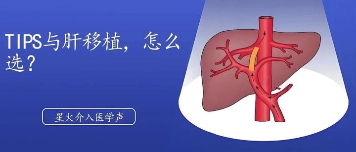 TIPS与肝移植,怎么选? - 知乎