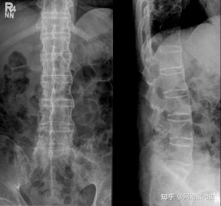 强直性脊柱炎x线图片图片