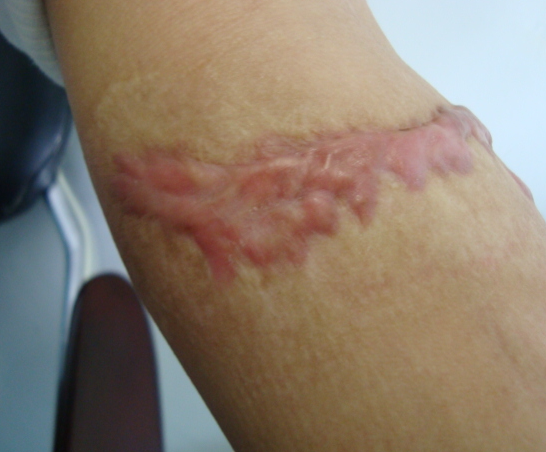 皮肤损伤愈合后疤痕总会或多或少红硬痛痒的表现这是什么原因呢