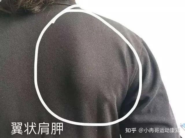做俯卧撑发现自己翼状肩胛特别严重并且后背不对称怎么改善? - 知乎