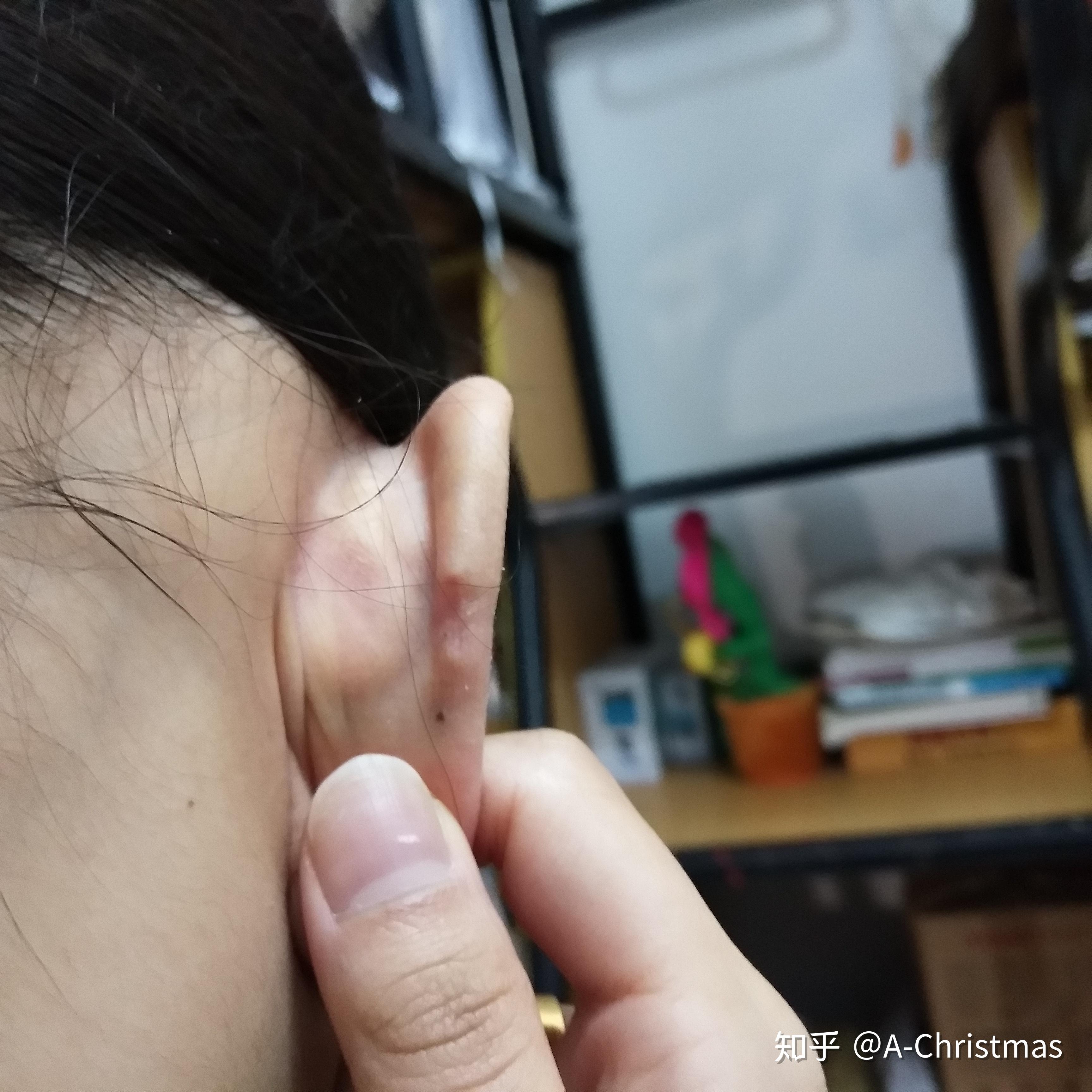 打了耳洞后长了个肉球的糟糕状况啊,,看了那么多医生都说是疤痕增生
