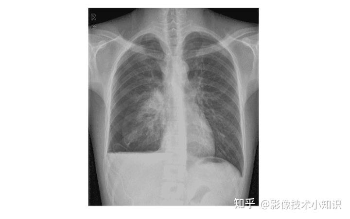 图+影像诊断报告(气胸) - 知乎