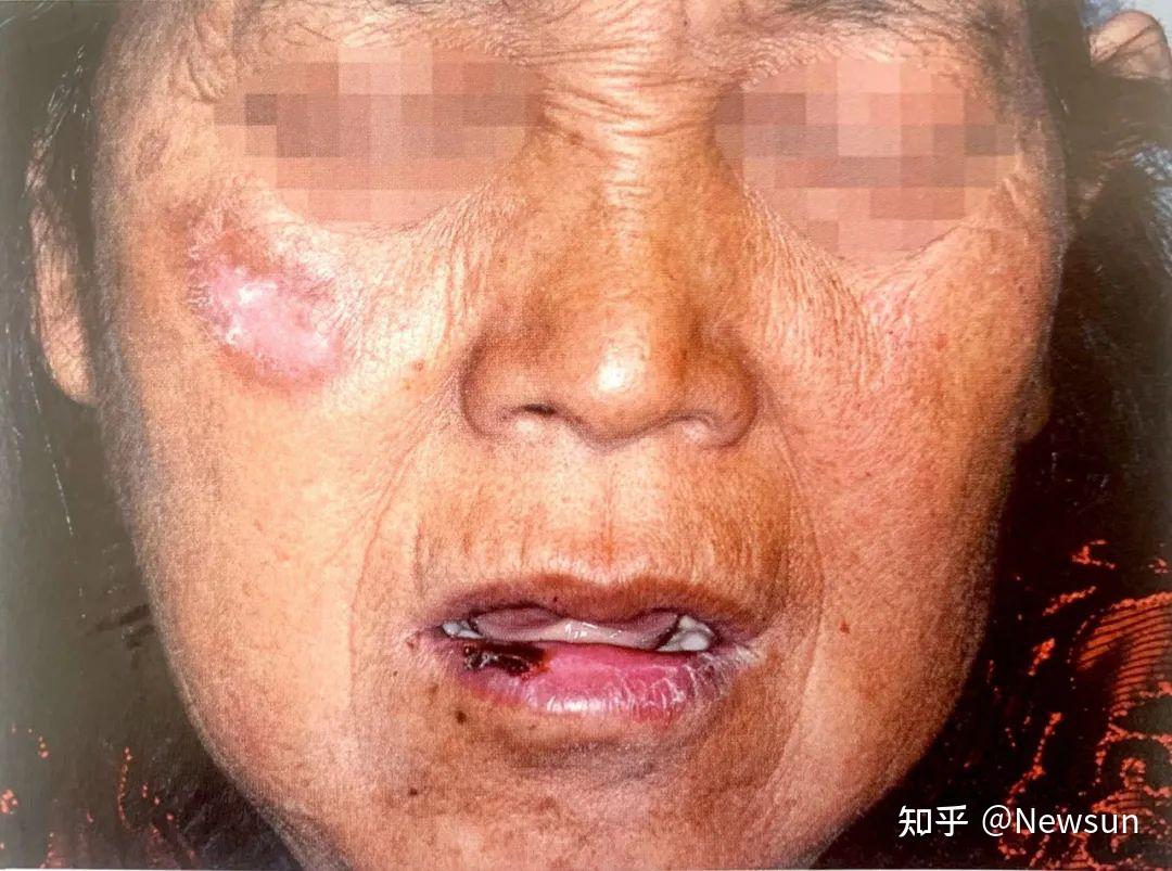 盘状红斑狼疮有哪些症状表现?
