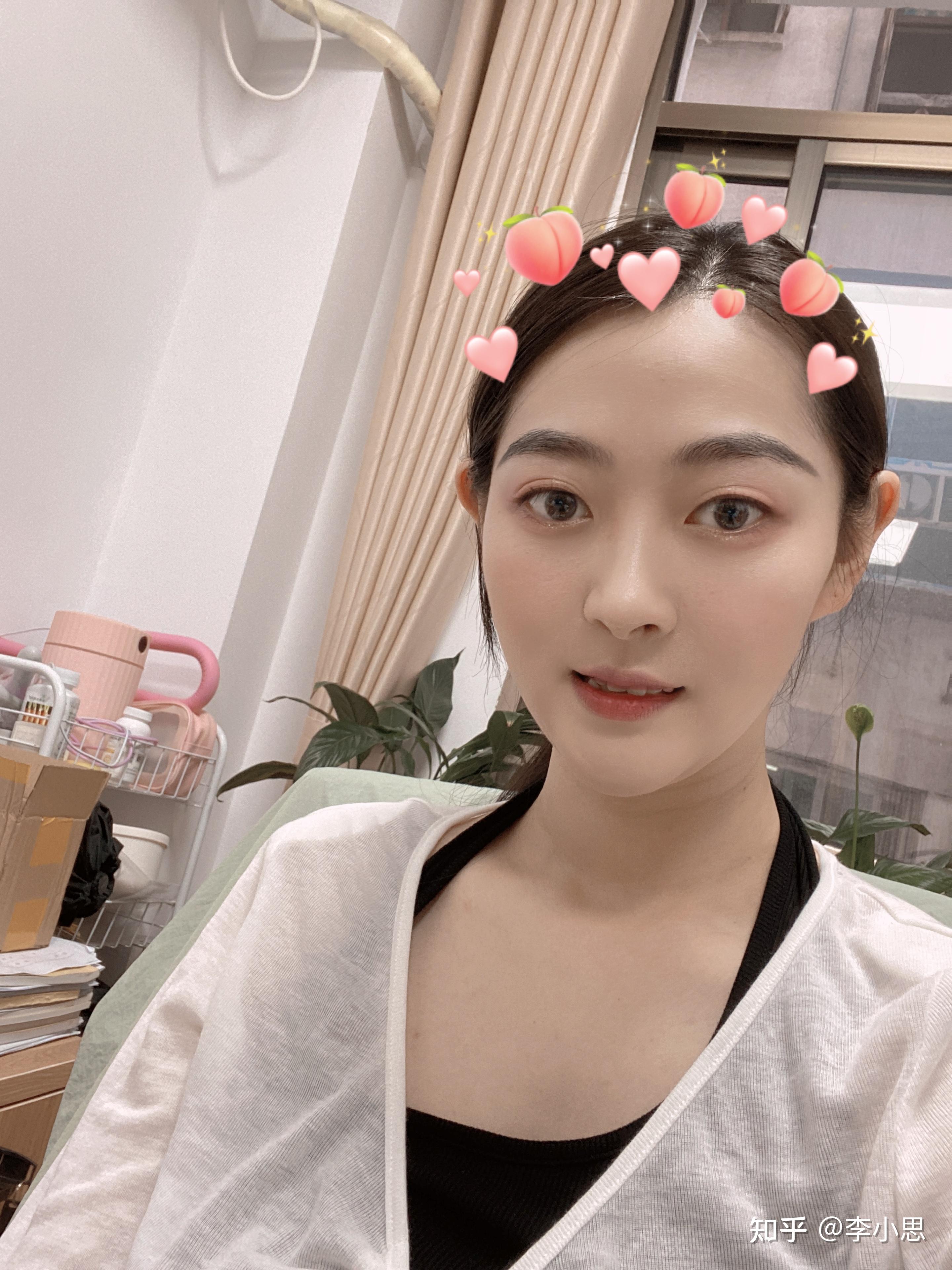 吃糖皮质激素引起的满月脸可以完全恢复吗? - 知乎