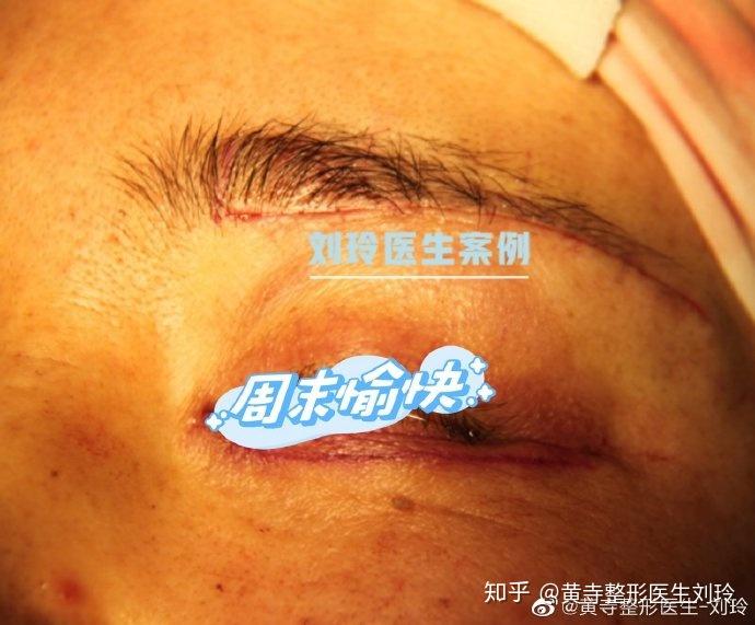 眉上切口提眉一定会留疤吗